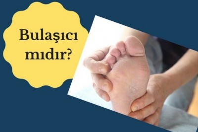 Ayak mantarı belirtileri nelerdir? Tedavisi nasıl olur?