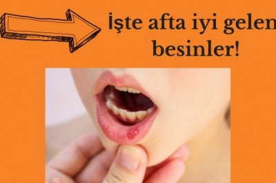 Aft (ağız yaraları) nedir neden çıkar? Aft belirtileri ve tedavisi