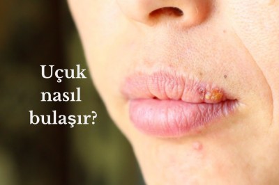 Uçuk (Herpes Simpleks) neden çıkar? Uçuğun nedenleri ve tedavisi